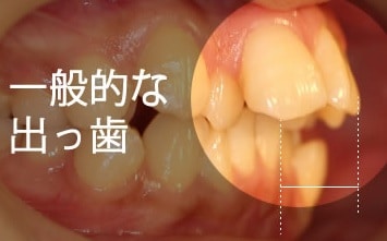 一般的な出っ歯